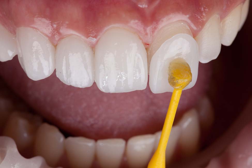 Anbindung Veneers auf Zahn